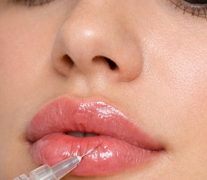 Preenchimento labial 1 ml